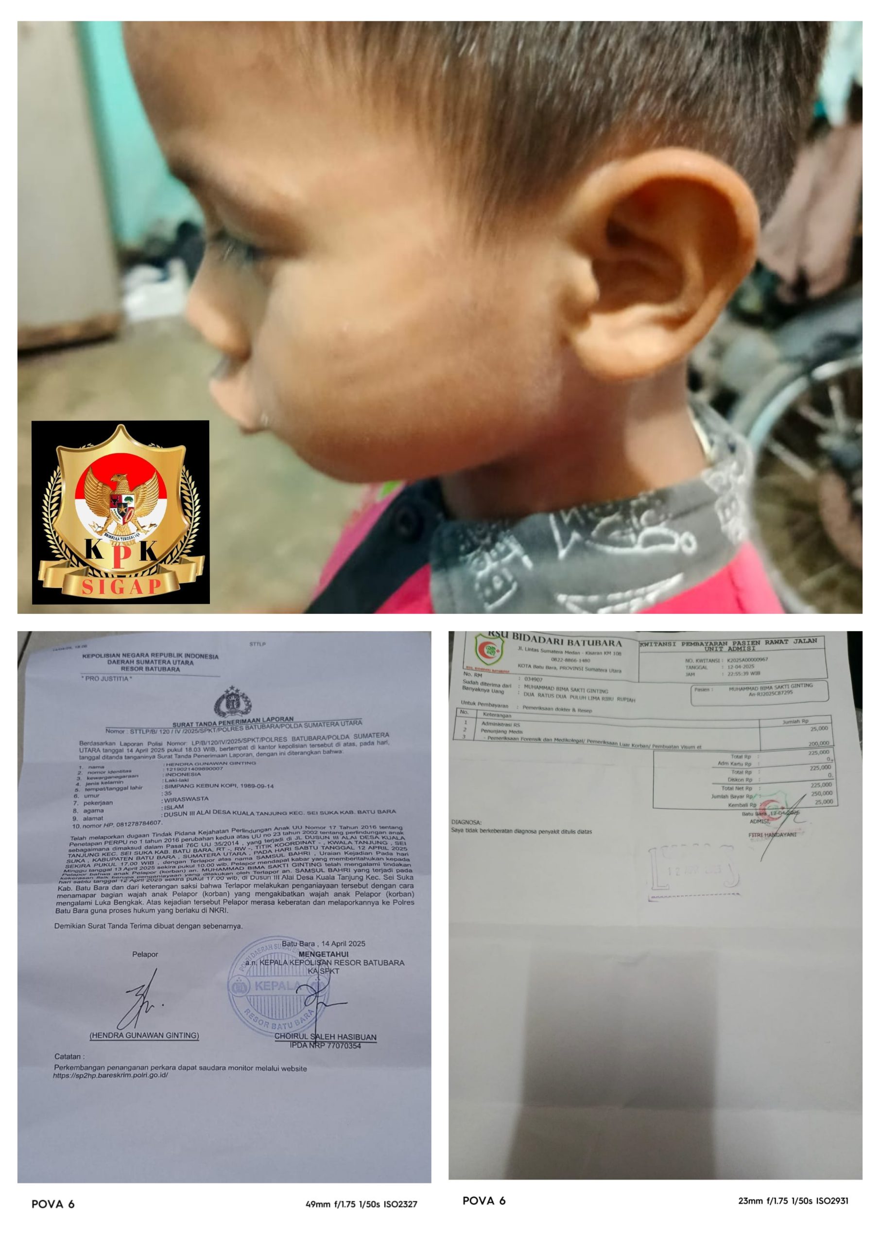 Tindak Kekerasan terhadap Anak 5 Tahun di Kuala Tanjung, Orang Tua Menjerit Minta Keadilan